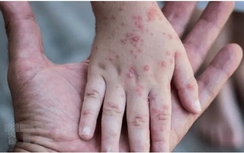 63% ca mắc đậu mùa khỉ nhiễm HIV, hầu hết là nam giới