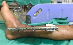 Nối thành công bàn chân đứt lìa cho nam thanh niên bị TNGT