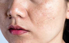 Cách nào để phòng tránh nám sạm da?