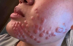 Rước vạ vì ham làm đẹp cấp tốc đón Tết