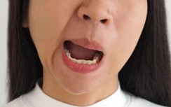 Nhiều người méo miệng, đột quỵ vì giá lạnh