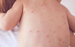 Trẻ bị sởi có cần kiêng gió, kiêng nước?