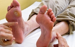 Biến chứng đái tháo đường có nghiêm trọng?