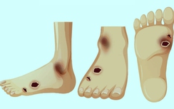 Tránh biến chứng bàn chân ở người mắc tiểu đường