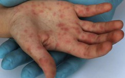 Một trường hợp nghi mắc bệnh đậu mùa khỉ, Chủ tịch tỉnh Cà Mau chỉ đạo nóng