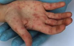 Cà Mau công bố kết thúc ổ dịch đậu mùa khỉ đầu tiên