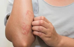 Mùa nồm ẩm, nhiều người bội nhiễm vì ngứa ngáy