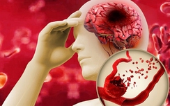 Dấu hiệu nào nhận biết đột quỵ?