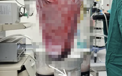 Bóc tách thành công khối u buồng trứng 10kg cho cô gái 19 tuổi