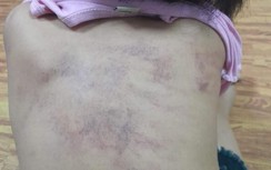 Bé 5 tuổi nghi bị bạo hành tại trường học: Chủ tịch Hải Phòng chỉ đạo gì?