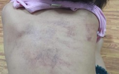 Thông tin chính thức vụ bé 5 tuổi nghi bị bạo hành tại trường học ở Hải Phòng