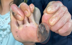 Thấy mảng đen trên da, đi khám phát hiện ung thư