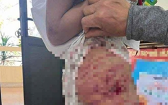 Hà Tĩnh: Xác minh vụ bé gái lớp 5 nghi bị cha dượng bạo hành