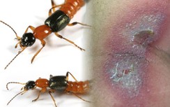 Nam thanh niên chảy dịch toàn thân vì đắp kiến ba khoang chữa ngứa