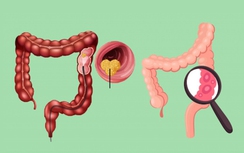 Cách nào để kiểm soát ung thư đại tràng?