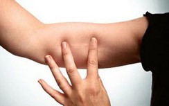 Que tránh thai hóa dị vật đi lạc sâu vào bắp tay