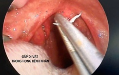 Cụ bà ho dai dẳng nhiều tuần, bất ngờ thủ phạm ẩn mình trong amidan