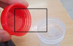 Phát hiện ký sinh trùng dài gần 10cm trong mắt một phụ nữ