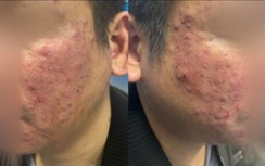 Tưởng mụn trứng cá, người đàn ông bất ngờ phát hiện viêm da do ký sinh trùng ít người biết