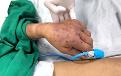 Cụ ông nguy kịch vì nhiễm liên cầu lợn sau 3 ngày ăn tiết canh