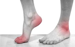 Khớp ngón tay, chân nam thanh niên biến dạng vì bệnh gout
