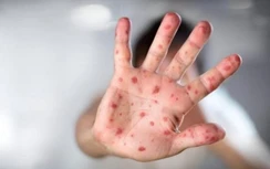 Chưa hết tay chân miệng lại nỗi lo sốt xuất huyết, ứng phó ra sao?