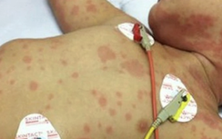 TP.HCM ghi nhận ca tử vong do não mô cầu, cảnh báo bệnh diễn tiến cực nhanh