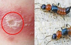 Bác sĩ cảnh báo không chủ quan với tổn thương do kiến ba khoang gây ra