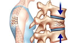 Biến chứng xẹp gãy đốt sống vì chủ quan với loãng xương