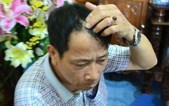 CSGT bị "ma men" đánh chấn thương sọ não kể lại phút đối mặt