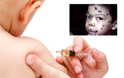 Phòng bệnh thủy đậu bằng vaccine