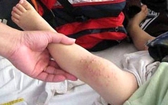 Người lớn có bị lây bệnh tay chân miệng không?