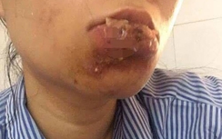 Kinh dị môi biến dạng vì thẩm mỹ