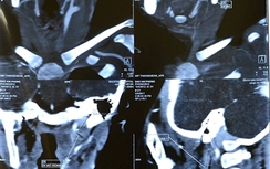 Cứu sống bệnh nhi bị cây đâm xuyên họng lên sọ