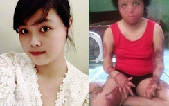 Thiếu phụ bị chồng tẩm xăng đốt bây giờ ra sao?