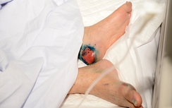 Đái tháo đường, tảng băng chìm nguy hiểm