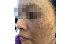 “Hoa cà, hoa cải” nổi đầy mặt sau trị nám bằng laser