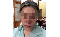 Rước họa vì làm đẹp bằng chất làm đầy