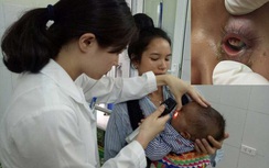 Thêm bệnh nhi hỏng mắt vì nhỏ sữa mẹ chữa đau mắt