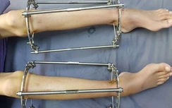 Nắn chỉnh, kéo dài chân làm đẹp coi chừng tai biến