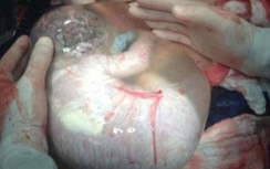 Đỡ đẻ thành công ca sinh non, trẻ còn nguyên trong bọc ối