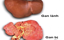 67% người dân quan niệm ung thư là chết