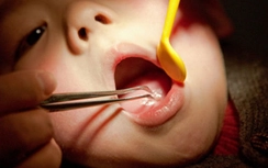 Cảnh báo nguy hiểm khi trẻ nuốt dị vật