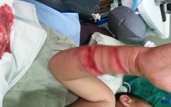 Trẻ 4 tuổi nhập viện vì bị cá sấu cắn