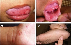 Hà Nội: Tăng nhanh các ca mắc bệnh tay chân miệng