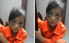 Cô giáo đánh nữ sinh bầm mặt: Điều tra, củng cố hồ sơ