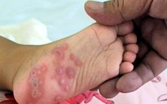 Cách điều trị hiệu quả bệnh tay chân miệng ở trẻ