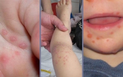 Phân biệt tay chân miệng và nhiệt miệng ở trẻ nhỏ thế nào?