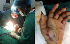 Đốt pháo tự chế, bé 12 tuổi trọng thương