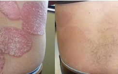 Duy trì thời kỳ phục hồi cho bệnh nhân vảy nến